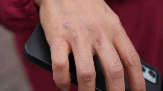 Facia anı: Komşular üstümü söndürsün diye kendimi dışarı attım