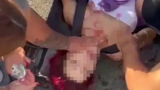 Sürat motoruyla hız faciayla bitti, metrelerce sürüklenen kızın kolu kopma noktasına geldi