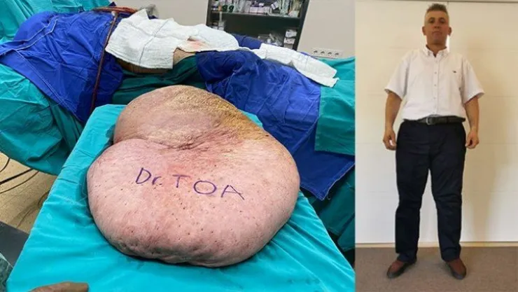 Bedeninden tam 35 kiloluk kitle çıktı!